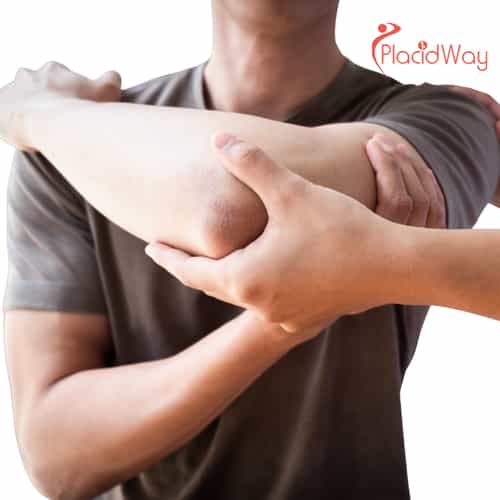 5 Dinge, die Sie über eine Rotatorenmanschettenoperation in Istanbul, Türkei, wissen sollten